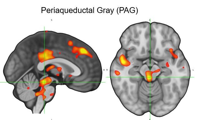 Side view and top view of a brain scan, with activity in different areas highlighted.